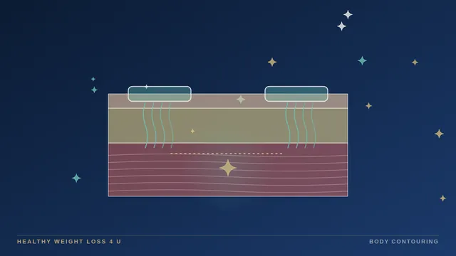 Abdominal cutaway with electrode pads sending pulses to a contracting abdominal muscle beside a waveform graph