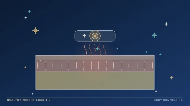 Illustration of a radiofrequency applicator over a cross-section of skin with face and body treatment areas marked
